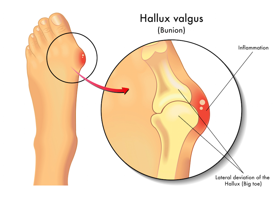 Bunion-surgery-Heart-Surgeons-in-India