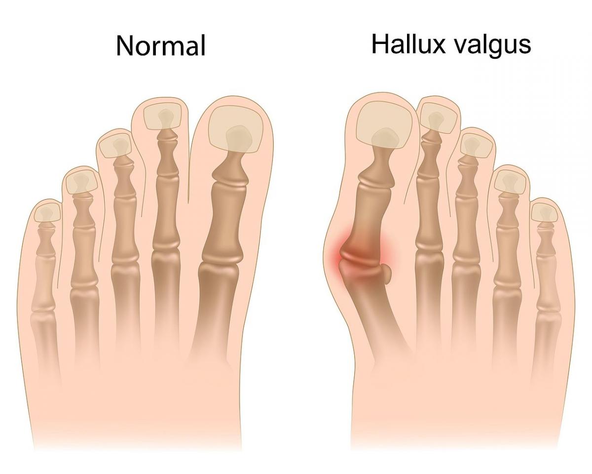 Bunion-surgery-Heart-Treatment-India-Heart-Surgery-in-Indi Bunion-surgery-Heart-Treatment-India-Heart-Surgery-in-Indi
