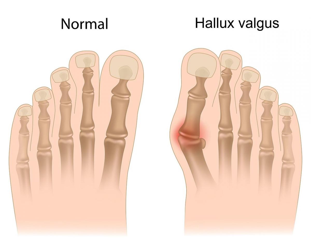 Bunion surgery - Doctorvalley