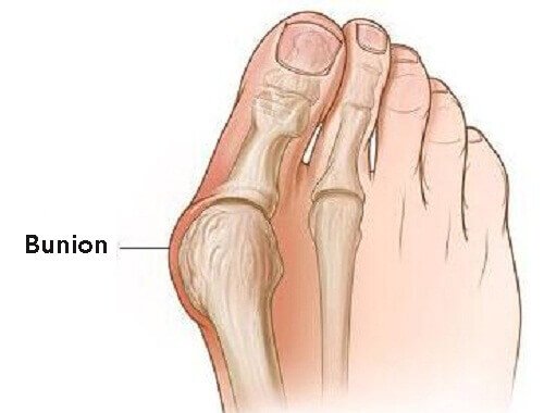 Bunion-surgery-Top-Heart-Surgery-Hospitals