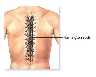 Cervical-Surgery