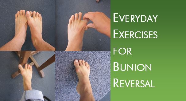 bunion-surgery bunion-surgery