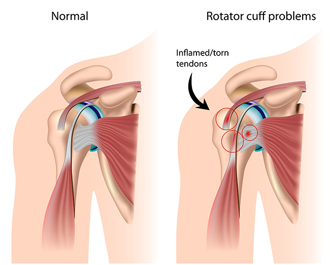 shoulder-dislocation-surgery-cost-in-india-rotator-cuff-surgery-cost-in-mumbai